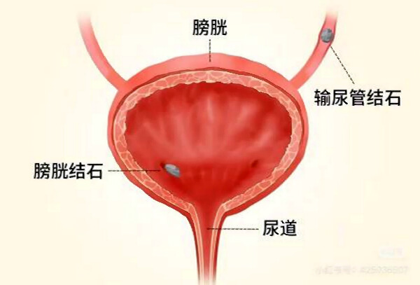 膀胱结石.jpg